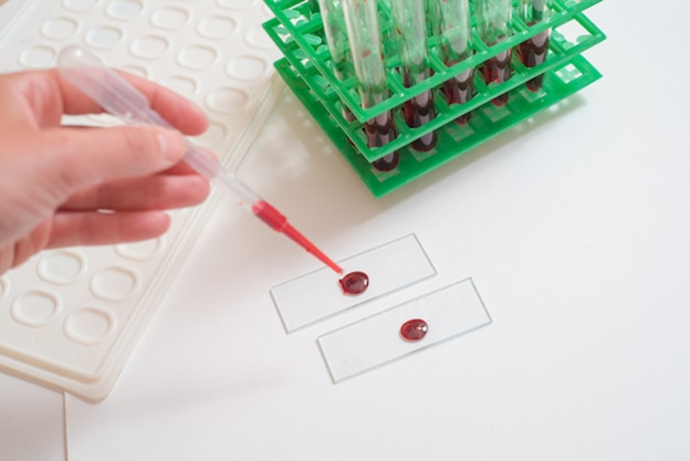 10 Key Questions Answered About Sedimentation Rate Blood Tests